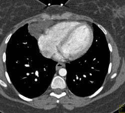 Pericardial Cyst - CTisus CT Scan