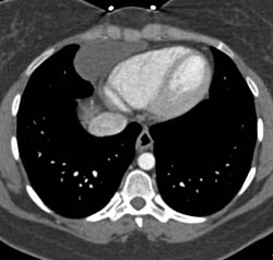 Pericardial Cyst - CTisus CT Scan