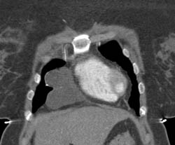 Pericardial Cyst - CTisus CT Scan