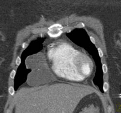 Pericardial Cyst - CTisus CT Scan