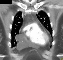 Pericardial Cyst - CTisus CT Scan