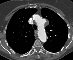 Aneurysm Off Arch - CTisus CT Scan