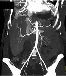 Vessels to Diaphragm - CTisus CT Scan