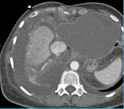 Large Pericardial Effusion - CTisus CT Scan