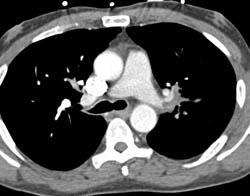 Pulmonary Embolism - CTisus CT Scan