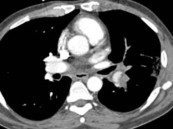 Pulmonary Embolism - CTisus CT Scan