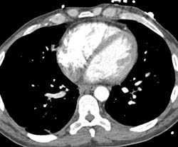 Pulmonary Embolism - CTisus CT Scan