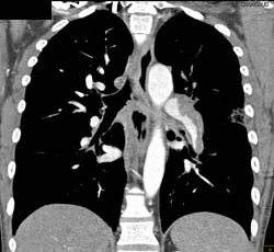 Chronic Pulmonary Embolism (PE) and Acute PE - CTisus CT Scan