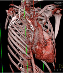 Total Anomalous Pulmonary Venous Return (TAPVR) - Nice 3D Mapping of Vessels - CTisus CT Scan