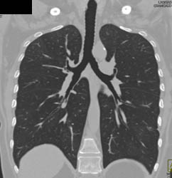 Normal Virtual Bronchoscopy With Inspiratory and Expiratory Views - CTisus CT Scan