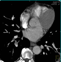 Pe - CTisus CT Scan