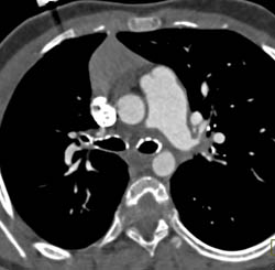 Pulmonary Artery Stenosis and Calcified Tracheal Rings- Or Keutel Syndrome - CTisus CT Scan