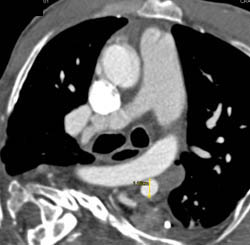 Aneurysm Off Aorta That Bleeds - CTisus CT Scan