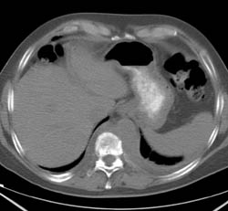 Lymphoma Erodes the Spine - CTisus CT Scan