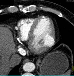 Pericardial Calcification - CTisus CT Scan