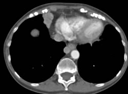 Paracardiac Nodes and Posterior Mediastinal Nodes - CTisus CT Scan