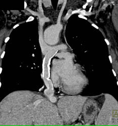 Stent From IVC to Pulmonary Artery - CTisus CT Scan