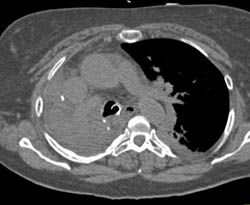 Consolidated Right Lung With Blood in Pleural Space - CTisus CT Scan