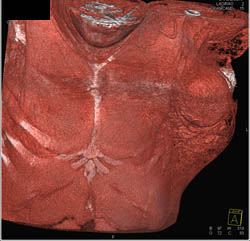 Arteriovenous Malformation (AVM) in Axilla and Left Breast S/P Embolization - CTisus CT Scan