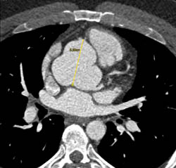 Dilated Aortic Root and Sinus of Valsalva - CTisus CT Scan