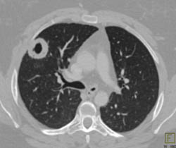 Wegener's Granulomatosis With Cavitary Lung Nodules and Tracheal Stenosis - CTisus CT Scan