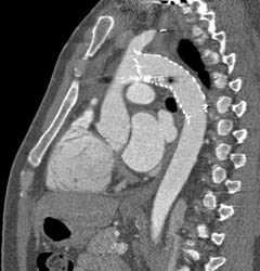 Stent in Arch S/P GSW - CTisus CT Scan