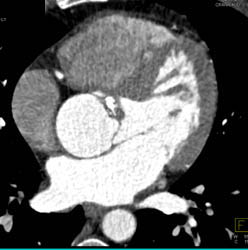 Bicuspid Aortic Valve - CTisus CT Scan