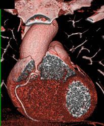 Dilated Aortic Root and Normal RCA - CTisus CT Scan