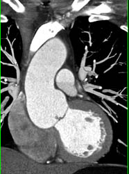 Dilated Aortic Root - CTisus CT Scan