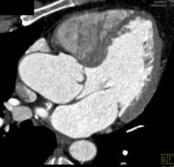 Dilated Aortic Root - CTisus CT Scan