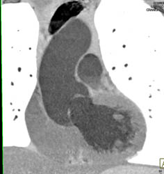 Dilated Aortic Root - CTisus CT Scan