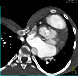 Severe Pectus Deformity - CTisus CT Scan