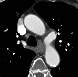 Ductus Aneurysm - CTisus CT Scan