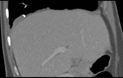 Plaques on Diaphragm - CTisus CT Scan