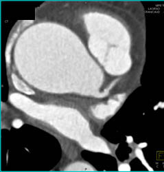 Dilated Aortic Root - CTisus CT Scan