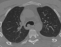 Polyp in Airway - CTisus CT Scan