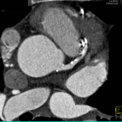 LAD Disease - CTisus CT Scan