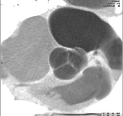 Diseased Av - CTisus CT Scan