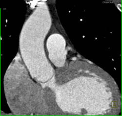 LAD Off Aortic Valve - CTisus CT Scan