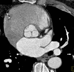 Aortic Valve in 3D and 4d - CTisus CT Scan