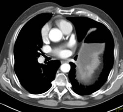 Elevated Diaphragm and High Positioned Stomach - CTisus CT Scan