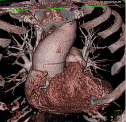 Dilated Aortic Root - CTisus CT Scan