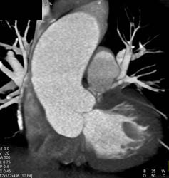 Dilated Aortic Root - CTisus CT Scan