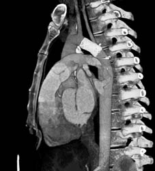 Stent in Arch for Repair of Coa - CTisus CT Scan