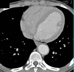 Takayasu's Arteritis With Involvement of the Left Main Coronary Artery and Branch Vessels Off the Arch - CTisus CT Scan