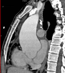 Dilated Aortic Root - CTisus CT Scan