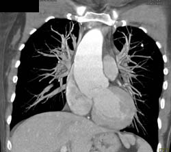 Dilated Aortic Root - CTisus CT Scan