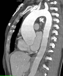 Dilated Aortic Root - CTisus CT Scan