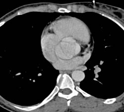 Open Aortic Root - CTisus CT Scan