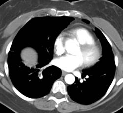 Pulmonary Embolism - CTisus CT Scan